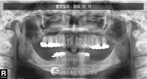 하악 어금니 임플란트뼈이식 관련 이미지 1