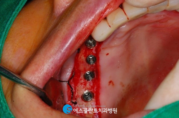 어금니임플란트로 건강한 식생활을 유지하세요! 관련 이미지 4