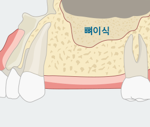 상악동 거상술 임플란트 주의사항 [에스플란트 치과병원] 관련 이미지 6