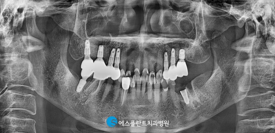 Gangnam Apgujeong Rodeo Dental Clinic: A Dental Clinic Skilled in Immediate Implant Placement After Extraction of a Loose Molar, S-Plant Dental Hospital image 5