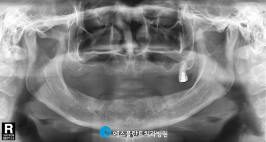 치아를 모두 상실했다면?전악임플란트로 자연치아와 같은 저작력을 되찾으세요! 관련 이미지 2