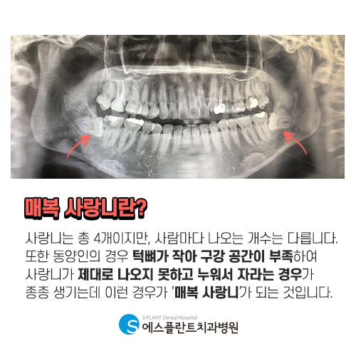 사랑니 발치도 세심하게 진행하는 에스플란트 치과병원 관련 이미지 3