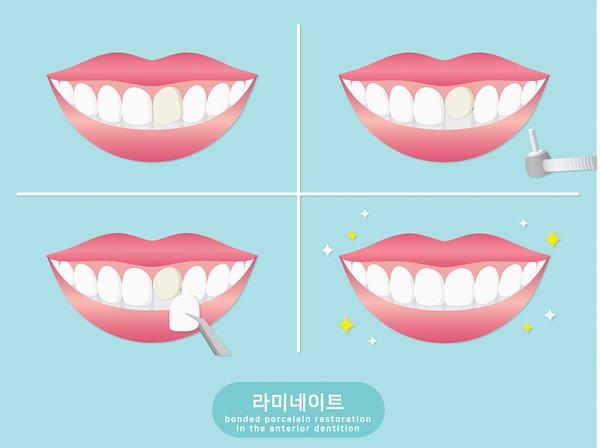 누런치아,손상줄이고하얗게만드는방법 관련 이미지 4