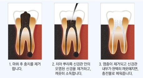 [치근단절제술] 썩은 치아 살린다? 미세광학현미경으로! 관련 이미지 2