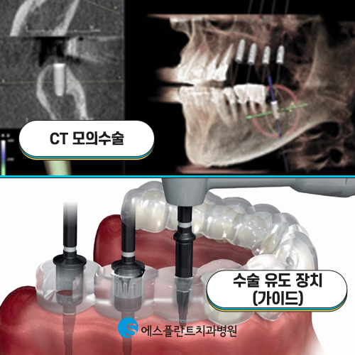 시간과 통증을 줄인 에스플란트의 즉시 기능 임플란트 관련 이미지 4