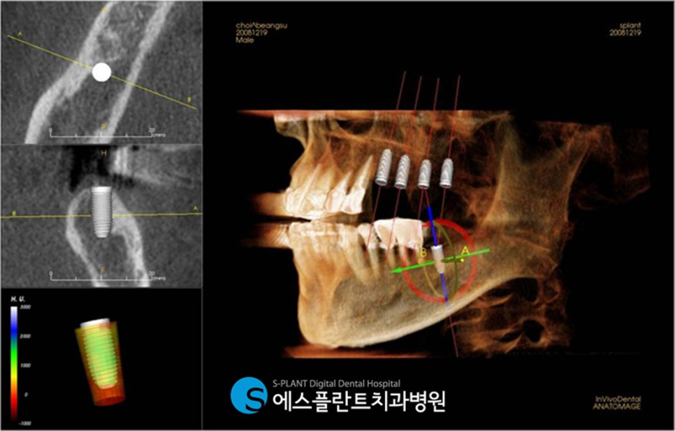 뻐 폭이 좁은 아래 앞니 임플란트 잘하는 치과, 강남 에스플란트치과병원 관련 이미지 2