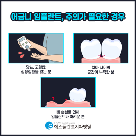 어금니임플란트 미루고 있다면? 관련 이미지 3