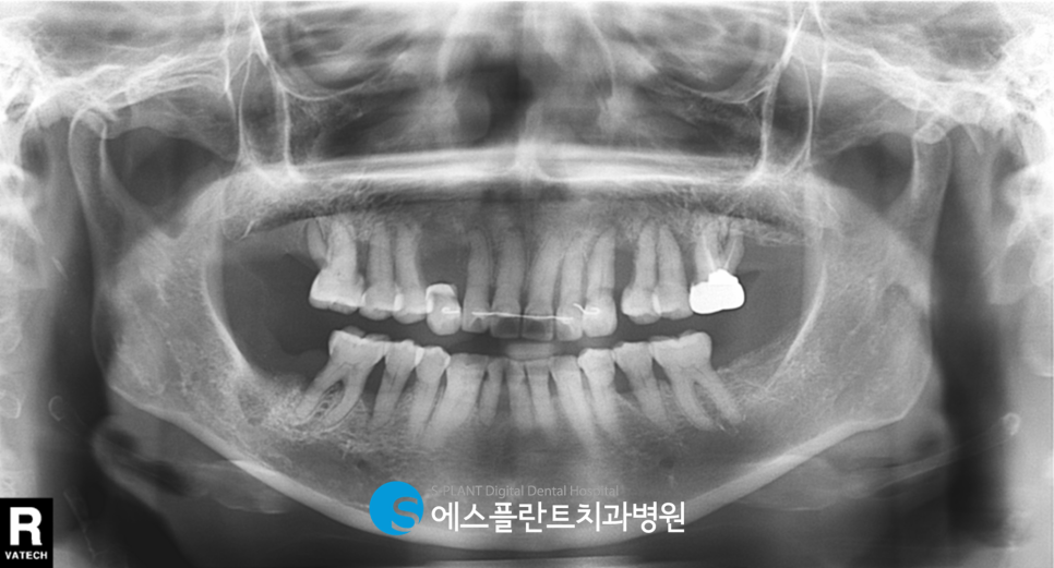 하악 앞니 임플란트 식립 잘하는 치과, 에스플란트 치과병원에서 정확하게! 관련 이미지 2