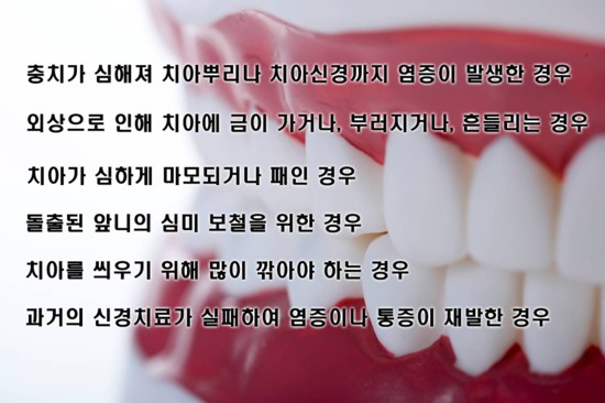 [치아 신경치료] 신경치료 과정과 필요한 경우는? 관련 이미지 3