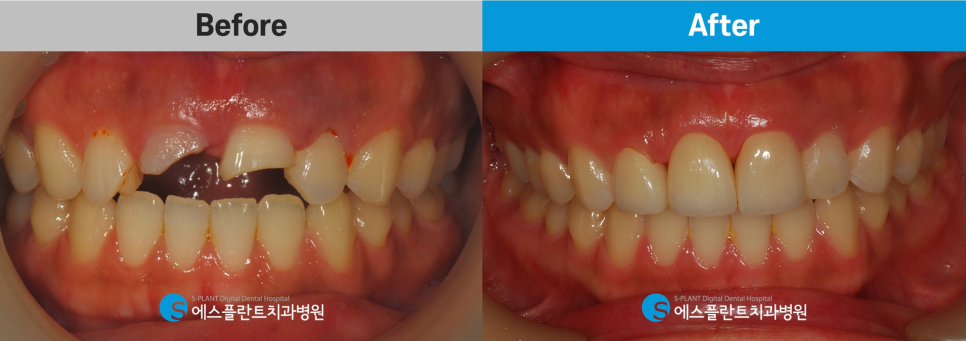 치아외상으로 인한 깨지고 부러진 치아, 강남 에스플란트치과병원에서 자연스럽게! 관련 이미지 7