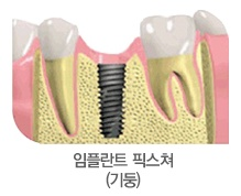 앞니임플란트 가격,앞니임플란트수술후두통있나요 관련 이미지 3