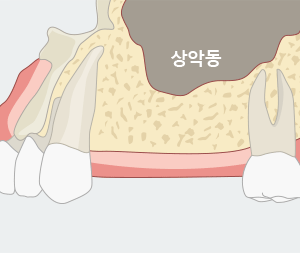 상악동 거상술 임플란트 주의사항 [에스플란트 치과병원] 관련 이미지 5
