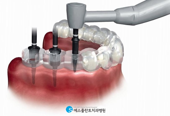 노인 임플란트, 편안하고 안전하게 진행하세요. 관련 이미지 4