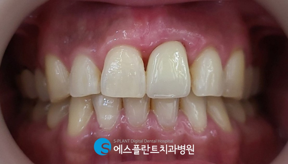 압구정로데오역 임플란트 잘하는 에스플란트치과병원, 당일 임플란트 발치 후 즉시 식립 임플란트 관련 이미지 6