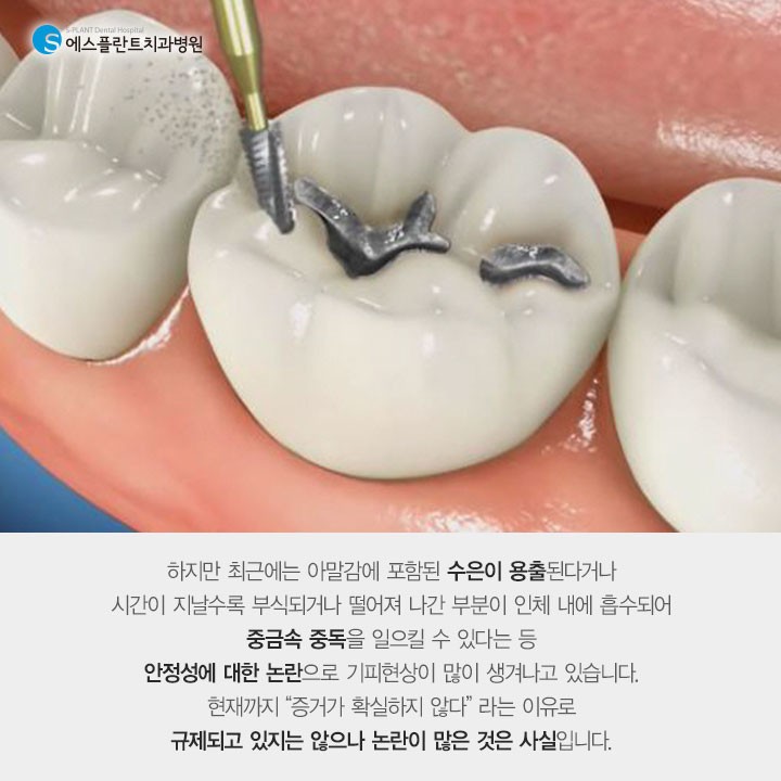 아무도 몰랐던 비밀스러운 [아말감] 관련 이미지 3