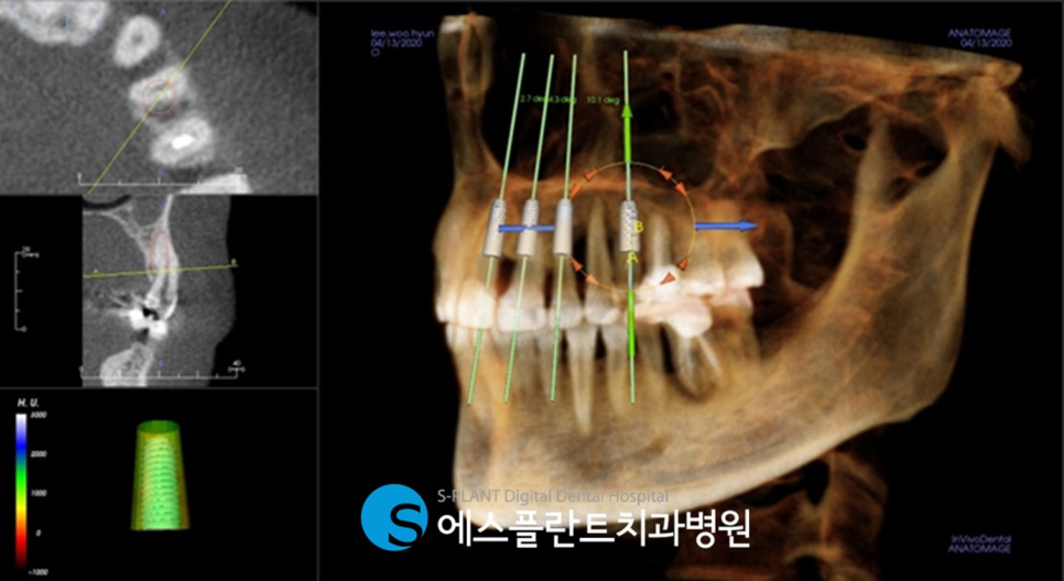 강남 디지털 가이드 임플란트를 통해 오차를 줄이며 안정적으로 식립 관련 이미지 3