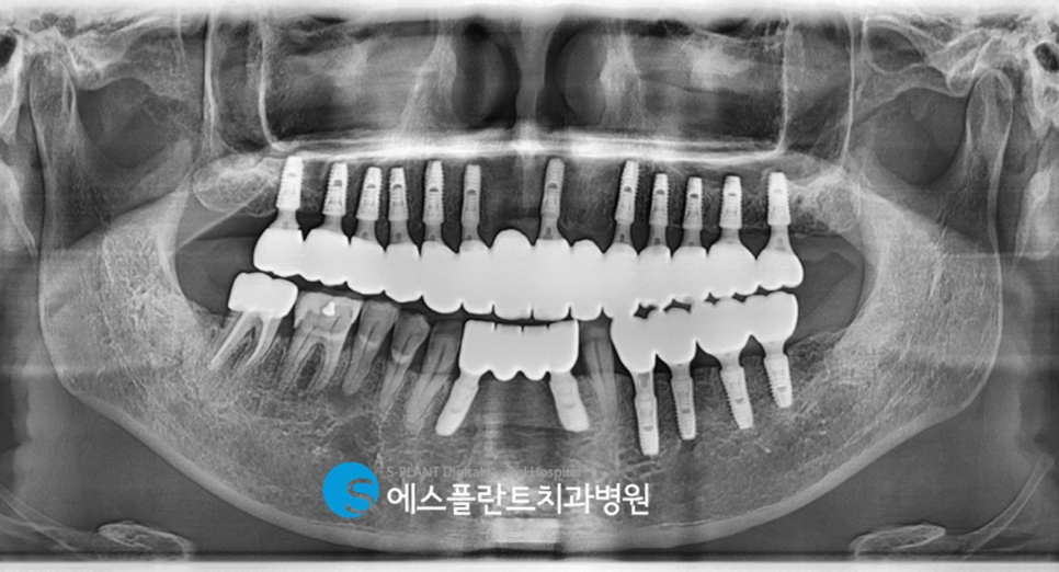 압구정 임플란트, 에스플란트치과병원의 편안하고 정확한 식립이 가능한 전악 가이드 임플란트 관련 이미지 11