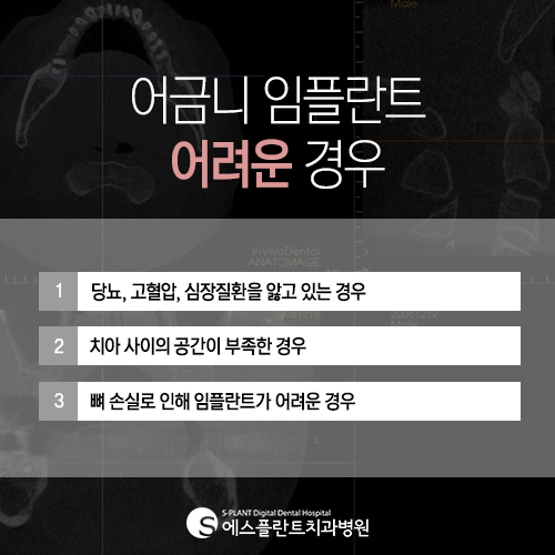 에스플란트 치과병원의 정확하고 안전한 어금니 임플란트 관련 이미지 5
