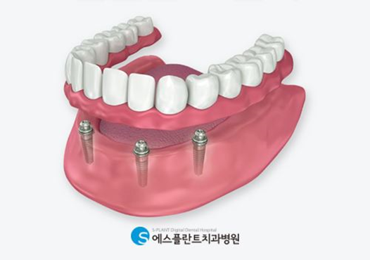 전체 치아를 상실했다면? 임플란트틀니 하세요. 관련 이미지 3