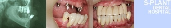 청담동 임플란트 재수술 시술방법과 진료대상 관련 이미지 1