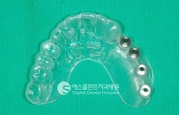 어금니 임플란트, 어금니 임플란트 시술과정 관련 이미지 11