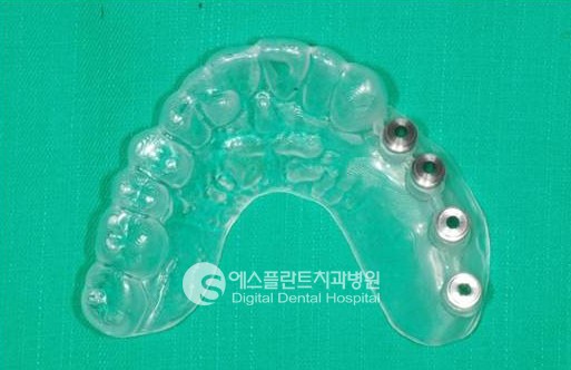 [어금니임플란트치과] 어금니 임플란트 가격, 어금니 임플란트 시술과 정 관련 이미지 5