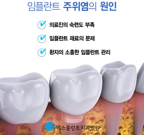 심각하면 재수술까지 이어지는 임플란트 주위염 예방방법은? 관련 이미지 3