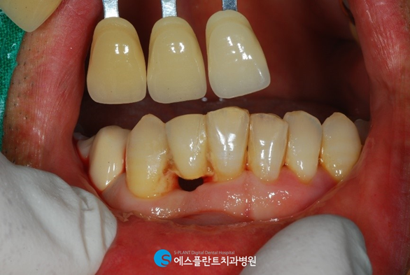 하악 전치부 치아손상, 임플란트로 심미성을 회복하세요! 관련 이미지 3