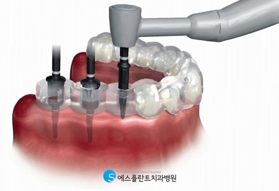 압구정로데오역치과 임플란트 잘하는 치과, 에스플란트 치과병원에서 실제로 사용하는 가이드 임플란트란?! 관련 이미지 2