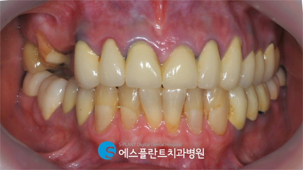 기능성과 심미성 모두 고려한 전치부 지르코니아 심미보철은 청담 에스플란트치과병원에서 관련 이미지 2
