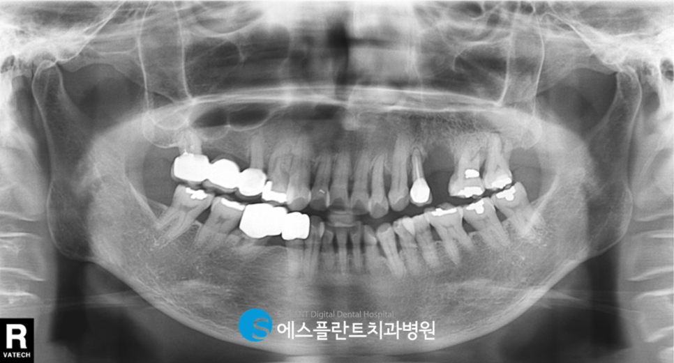 강남치과 에스플란트치과병원의 자가혈 임플란트(PRF)로 높은 성공률과 빠른 회복 관련 이미지 1
