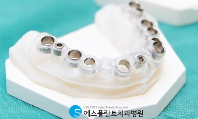 치료기간이 부담된다면? 당일임플란트 하세요. 관련 이미지 4