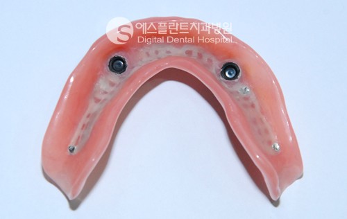 장점만 모아 만든 임플란트틀니 [에스플란트치과병원] 관련 이미지 10