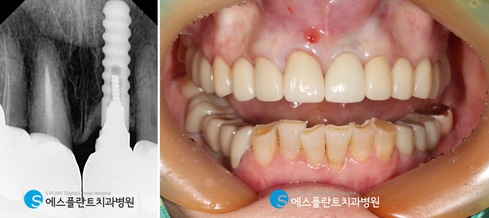 압구정로데오 치근단절제술, 과거 신경치료했던 앞니 뿌리에 염증이 생겼다면?! 관련 이미지 3