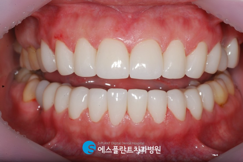 앞니 콤플렉스가 있다면?! 강남 심미보철 잘하는 치과, 에스플란트치과병원의 심미보철로 개선 관련 이미지 5