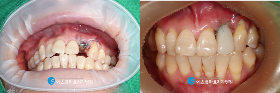 당일 임플란트 원데이 임플란트 수술이 가능한 강남치과, 에스플란트치과병원 관련 이미지 6