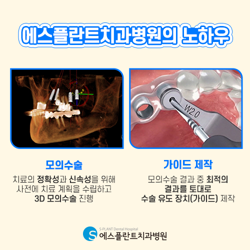 임플란트 당일 식립으로 빠른 치료 [에스플란트 치과병원] 관련 이미지 4