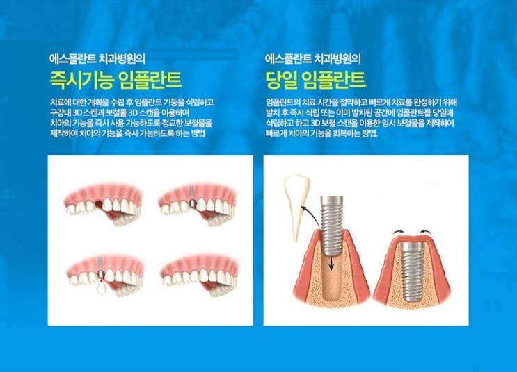 에스플란트치과병원 대학병원 임플란트 수준을 경험하다. 관련 이미지 8