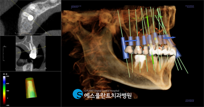 전체임플란트 이렇게 진행됩니다! 관련 이미지 2