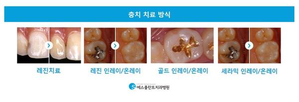 충치치료,내구성이뛰어난인레이로치아보존 관련 이미지 3