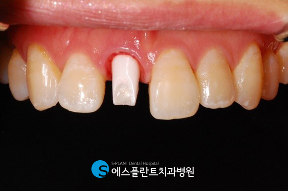 A case of regaining confidence with immediate implant placement after front tooth extraction at Esplant Dental Hospital, a dental clinic near Apgujeong Rodeo Station known for implants image 5