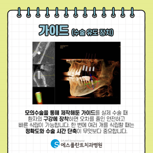 전악임플란트, 가이드를 이용해 수술시간은 줄이고, 정확성은 높이고! 관련 이미지 4