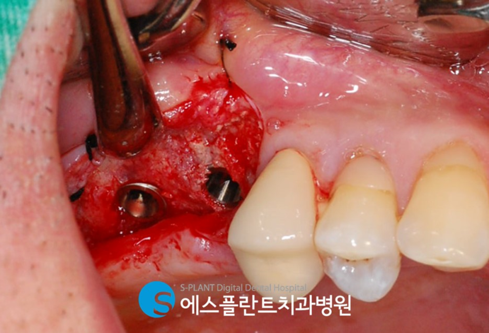 고난이도 상악동 거상술 임플란트 잘하는 치과, 에스플란트 치과병원 관련 이미지 7