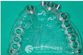 당일 임플란트, 즉시 임플란트는 아나토마지 가이드 임플란트로! 관련 이미지 7