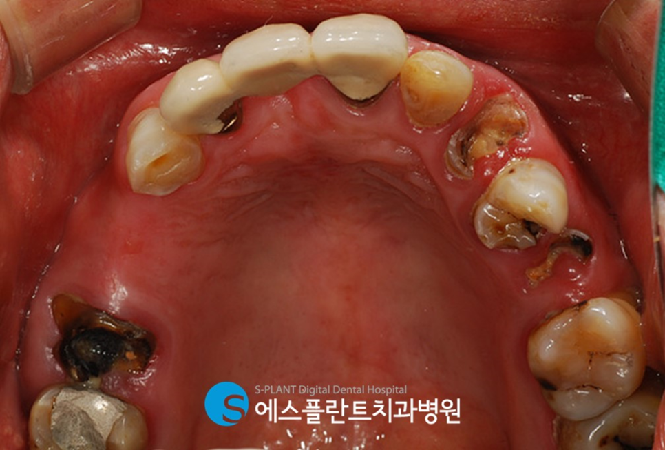 심한 충치로 인한 심미보철 및 임플란트 치료 잘하는 압구정로데오역 치과, 에스플란트치과병원 관련 이미지 2