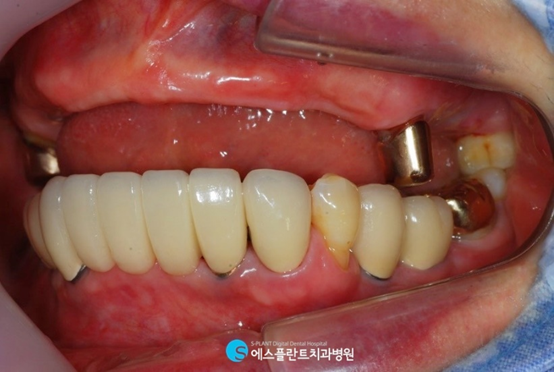 틀니가 헐겁고 불편하다면? 전악임플란트하세요.<에스플란트치과병원> 관련 이미지 4