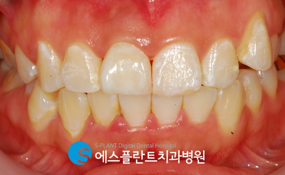강남 부러진 앞니 임플란트 잘하는 치과, 에스플란트치과병원(전치부 발치 즉시 임플란트 및 당일 임시치아 세팅) 관련 이미지 6