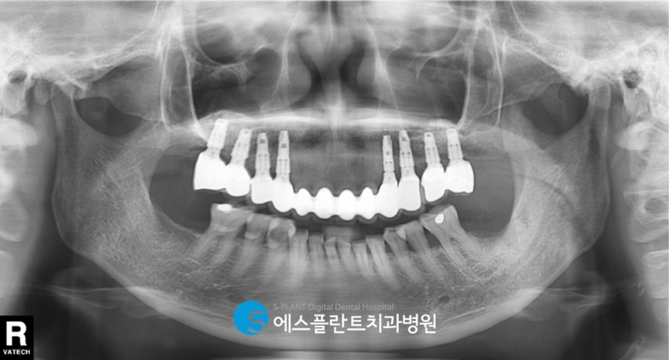 상악 무치악 환자 삶을 질을 높여주는 에스플란트치과병원의 상악 Full Case 임플란트 관련 이미지 4