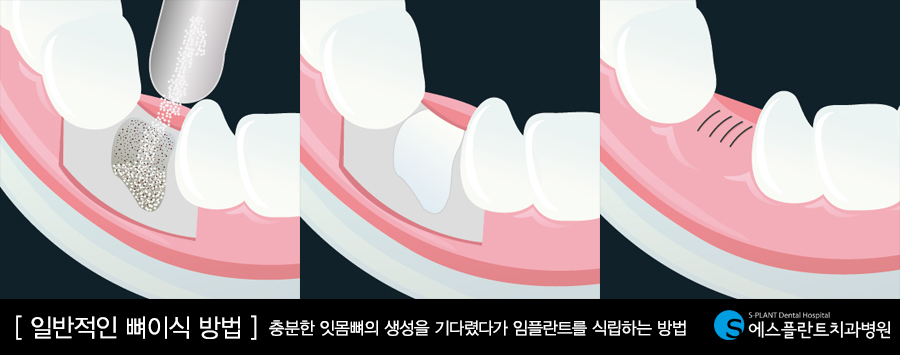 치조골이식술 뼈를 채워 단단한 임플란트 만들자 관련 이미지 5