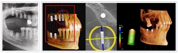 [CT임플란트] 3D CT 임플란트, 아나토마지 가이드 임플란트 관련 이미지 2